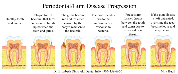 Gum Disease, Periodontist Brampton, Implant and Gum Specialist, 